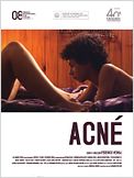 Acné