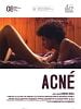 Cartel de Acné